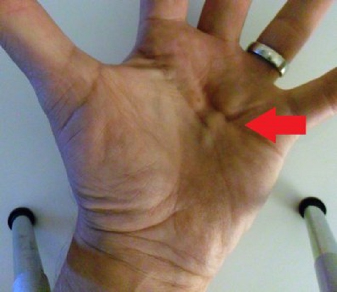 Dupuytren in de palm van mijn linkerhand